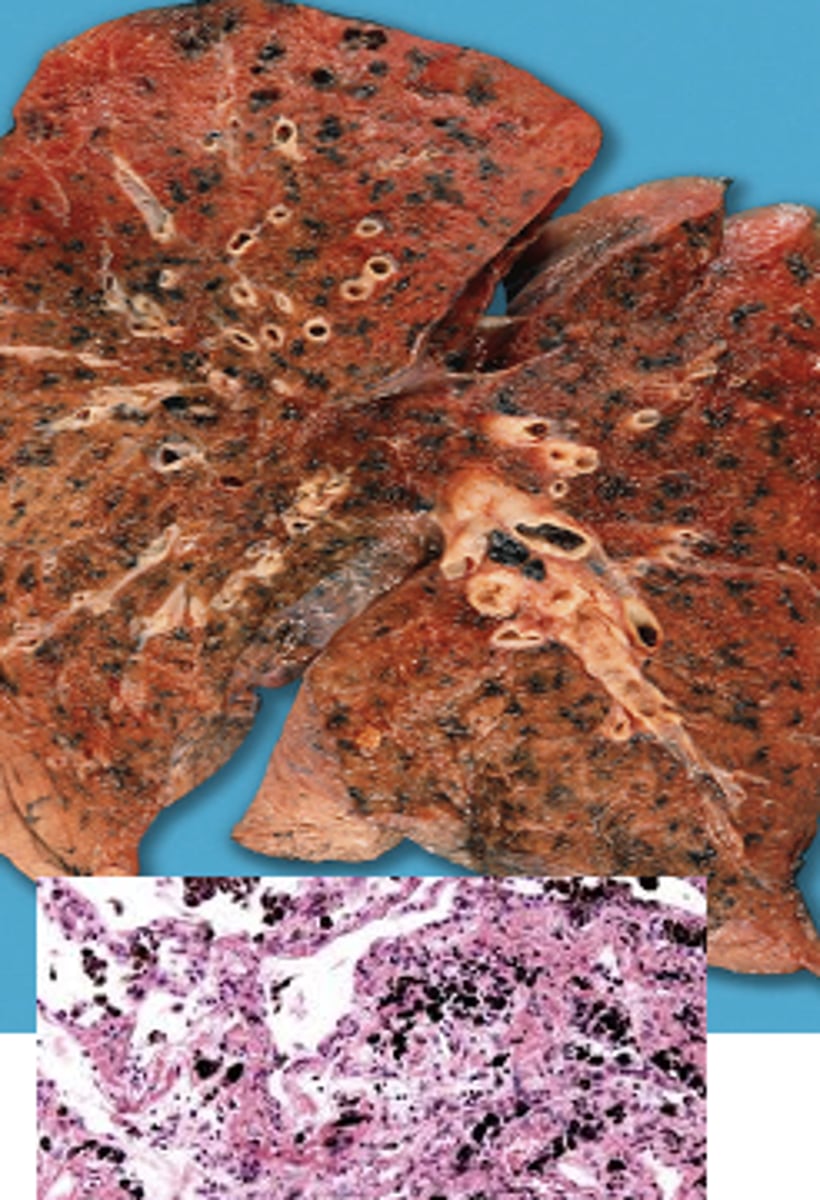 <p>black pigmentation referring to lung tissue and occurs with inhalation of particulate material that is stored in the lungs. Appears as patchy or streaks of black discoloration</p>