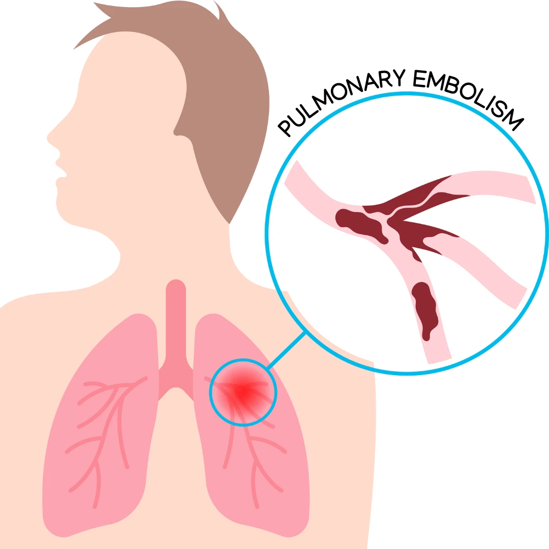 <p>A condition in which a <strong>blood clot blocks an artery in the lungs</strong>, reducing blood flow.</p>