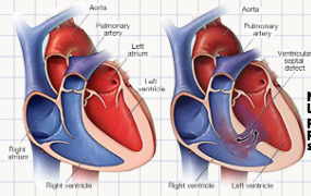 <p>Ventricular Septal Defect (VSD)</p><p>In a typical VSD, blood initially shunts from which specific chamber into which target structure/outflow tract?</p>