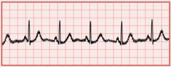 <p>Any electronic device on the patient or near the patient has the potential to cause it</p>