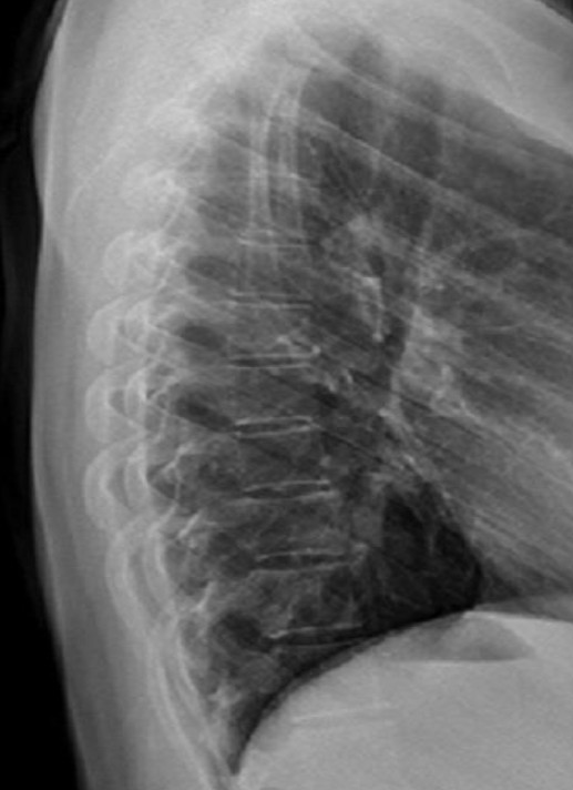 <p>Lateral Thoracic Landmarks</p>