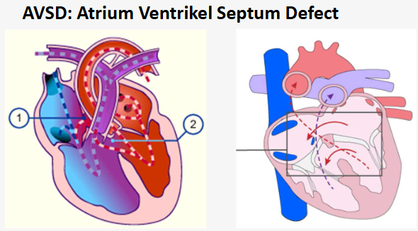 <p>Atrioventriculair septumdefect. Het komt veel voor bij personen met het syndroom van Down.</p>
