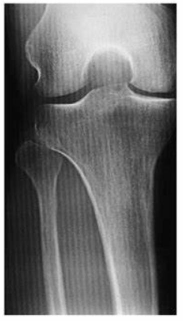 <ul><li><p>Also known as zebra pattern, is an artifact that can occur when a stationary grid is used during CR imaging.</p></li><li><p>If the grid frequency is similar to the laser scanning frequency during CR image processing, then a zebra pattern can result on the digital image</p></li><li><p>Use of a higher grid frequency or a moving grid with CR digital imaging eliminates this type of grid error</p></li></ul><p></p>