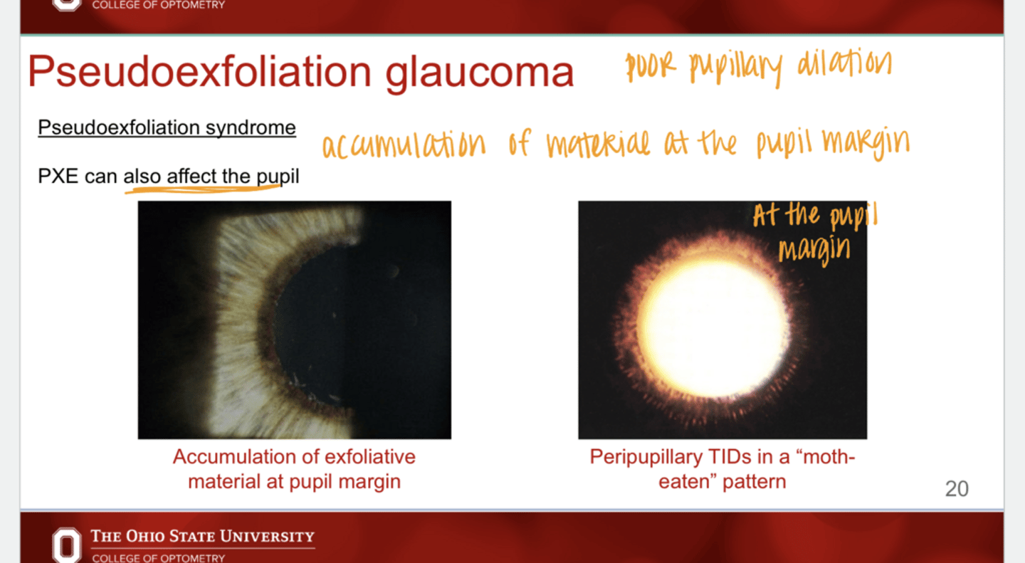 <p>Can PXE affect the pupil?</p>