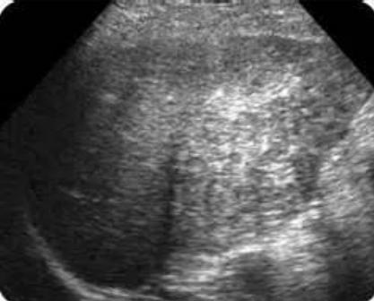 <p>which type of hepatitis is this showing (acute/chronic)</p>