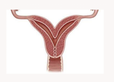 <p>Name the uterine anomaly </p>