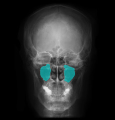 <p>Radiolucent space above posterior maxillary teeth</p>