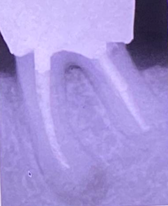 <p>﻿﻿It is the failure to remove pulp tissue, dentinal debris, and micro-organisms from the root canal system.</p><p>﻿﻿ treatment: "retreatment"</p>