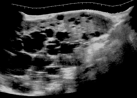 <p><span>A “Swiss cheese” appearance with numerous cysts that may blend together. </span></p><p><span>Document “multiple cysts” and measure a clearly defined or largest representative cyst rather than every cyst</span></p>