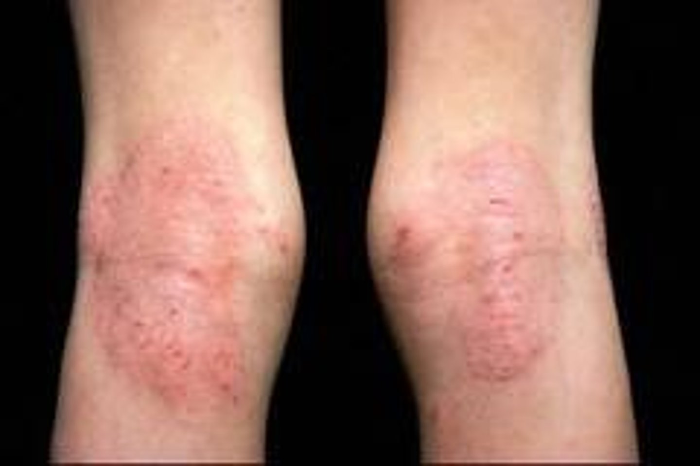 <p>eczema</p><p>-crusted patches</p><p>-goes with asthma and food allergies</p><p>-erythema, scaling, dry skin, intense itching</p>