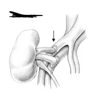<ul><li><p>most common anastamosis technique </p></li><li><p>connects illiac vessels to renal vessels</p></li></ul><p></p>