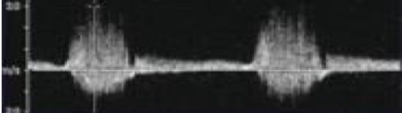 <p>Despite proper doppler optimization, what is the most likely explanation?</p>