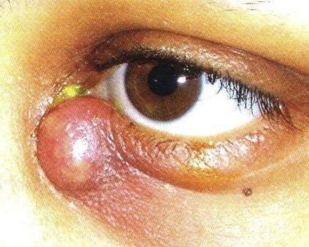 <ul><li><p>Acute infection of lacrimal sac</p></li><li><p>Signs:</p><ul><li><p>Painful</p></li><li><p>Redness</p></li><li><p>Tenderness over lacrimal sac</p></li><li><p>Purulent reflux </p></li><li><p>Epiphora</p></li></ul></li></ul><p></p>