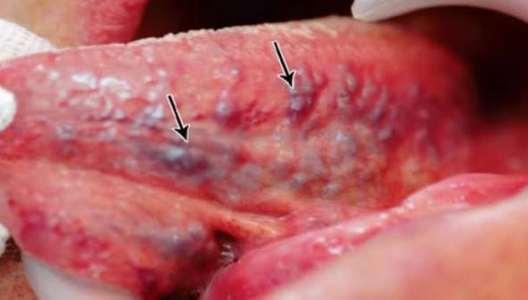 <ul><li><p>Bulging blood vessel, Caviar tongue </p></li></ul><p></p>
