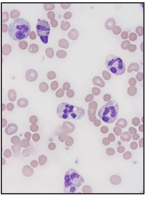 <p>Bacterial Infections</p>