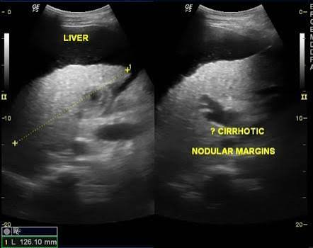 <p>diffuse parenchymal echogenicity, irregular nodular contour, no portal wall distinguish, enlarged caudate lobe, splenomegaly, ascites </p>