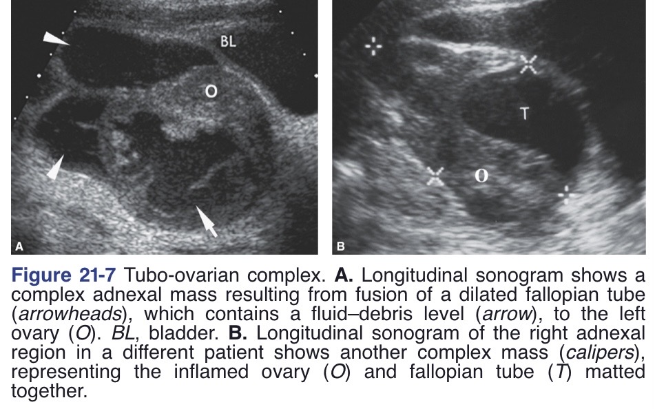 <p>‘Thickened, irregular endometrium</p><p>Pyosalpinx or hydrosalpinx</p><p>Cul-de-sac fluid</p><p>Multicystic and solid complex adnexal mass(es)</p><p>Ovaries and tubes recognized as distinct structures, but the ovaries will not be separated from the tube by pushing with the vaginal probe</p>