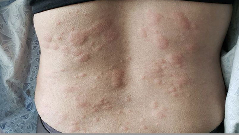 <p>allergic reaction to the skin</p><p>cause: histamine release in response to allergic reaction </p><p>symptoms: rash of white or red raised areas (wheals) of various sizes, can occur anywhere on the body </p><p>treatment: removal of triggering agent, oral antihistamine, possible need for systemic corticosteroids </p>