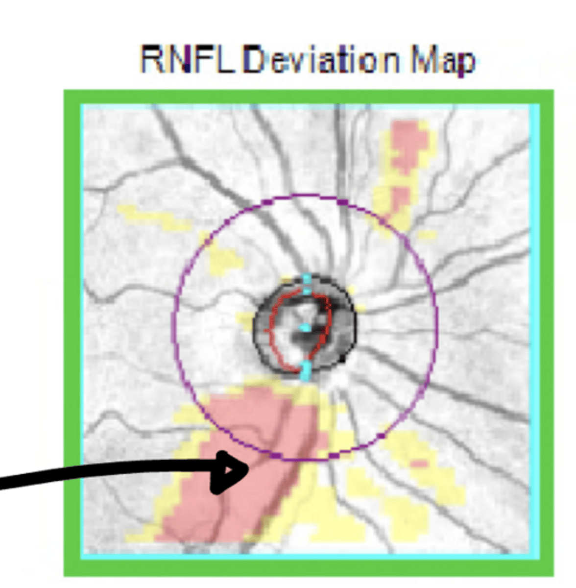 <p>RNFL Deviation Map for IT Drance Hemorrhage</p><p>**thin compared to normative data</p>