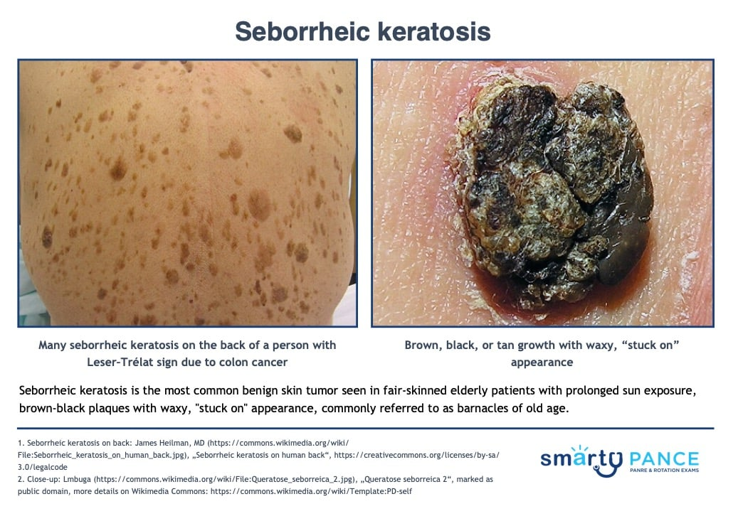 <p>Benign skin growth in older adults, which is a harmless overgrowth of surface skin cells </p><p>-Presentation: brown, waxy, “stuck on” plaques with a well-defined, rough surface. Found on the face, trunk, and extremities. Can be paraneoplastic clue to an internal cancer </p><p>-Dx: clinical, shave or punch biopsy </p><p>-Tx: none needed</p>
