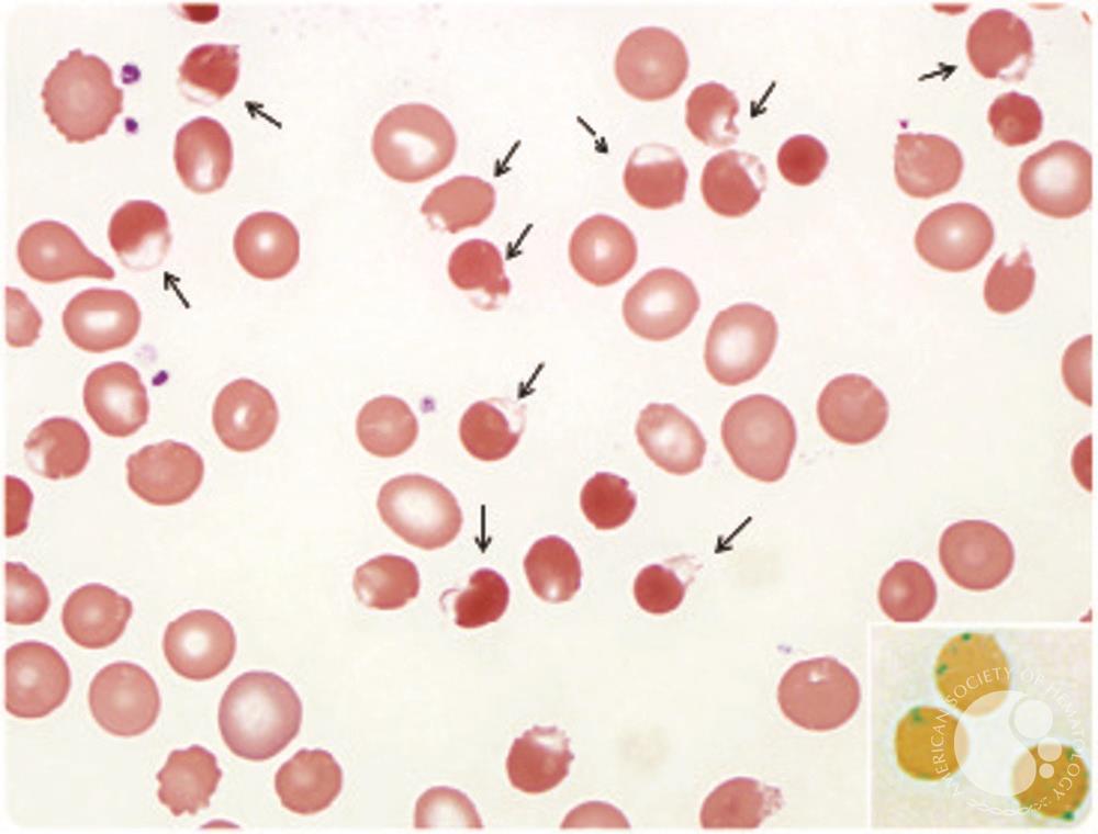 <p>heinz bodies</p>