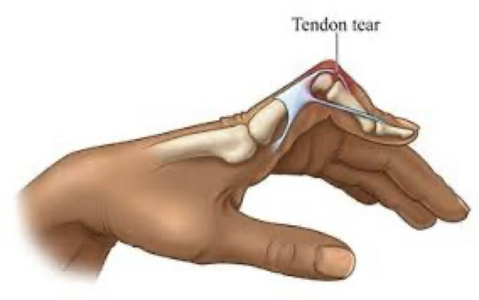 <p>boutonniere finger deformity</p>