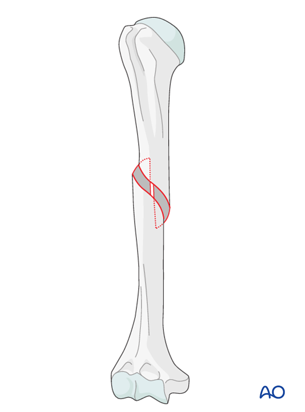 <p>break is S-shaped, usually caused by a twisting injury</p>