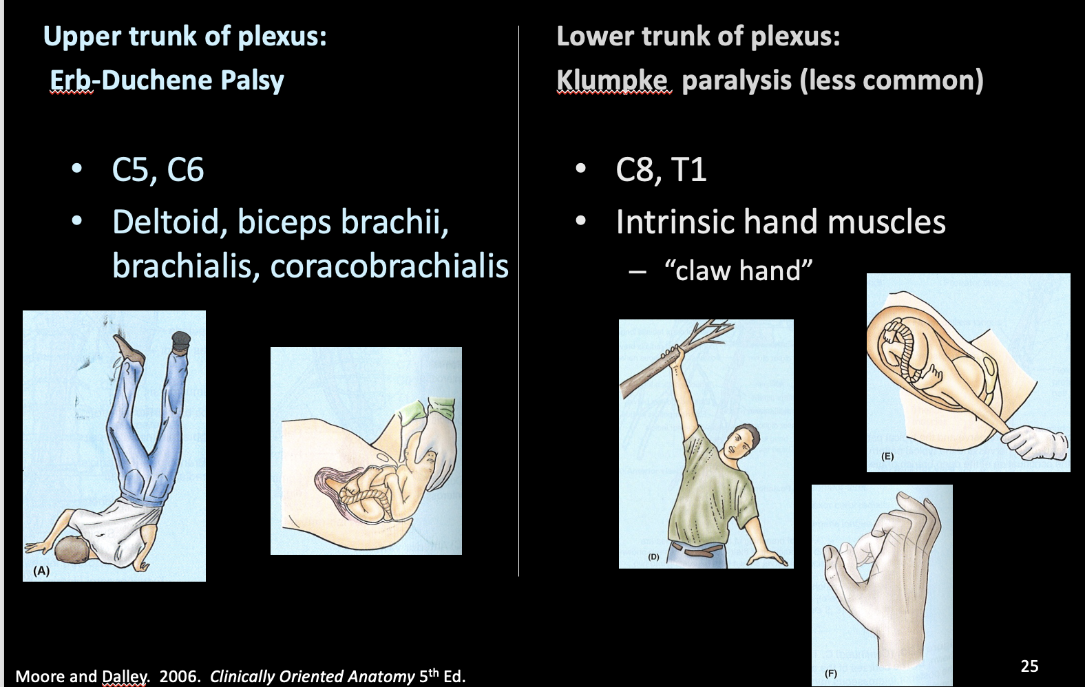 <p><strong>Upper/superior trunk of plexus: <mark data-color="yellow" style="background-color: yellow; color: inherit;">Erb-Duchene Palsy</mark></strong></p><p style="text-align: left;"><strong>-</strong>C5, C6</p><p>-Deltoid, biceps brachii, brachialis, coracobrachialis</p><p><strong>Lower/inferior trunk of plexus: <mark data-color="yellow" style="background-color: yellow; color: inherit;">Klumpke&nbsp; paralysis</mark> <mark data-color="purple" style="background-color: purple; color: inherit;">(less common)</mark></strong></p><p>-C8, T1</p><p>-Intrinsic hand muscles–“claw hand”</p>