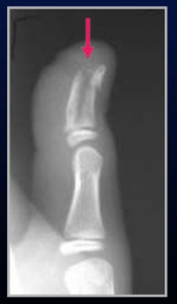 <p>Follows the long axis of the bone</p>