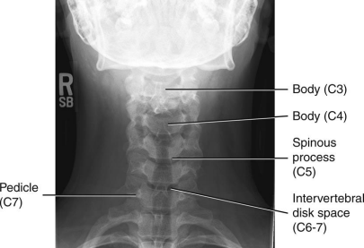 <ul><li><p>Angle CR 15 to 20 degree cephalad neck extended slightly</p></li><li><p>C3 to T2 demoed</p></li><li><p>Space between pedicles and intervertebral disk spaces clearly seen</p></li><li><p>Mandible and base of the skull should superimpose C1-2</p></li></ul><p></p>