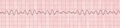 <p>defibrillation</p>