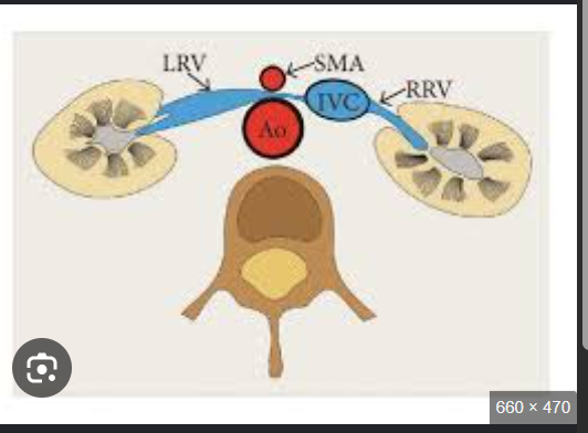 <p>Where does the left renal vein course from?<br>→ Left kidney</p><p>The left renal vein passes posterior to what artery?<br>→ SMA</p><p>The left renal vein passes anterior to what vessel?<br>→ Aorta</p><p>How does the left renal vein appear on longitudinal imaging?<br>→ Circular structure</p><p>How does the left renal vein appear on transverse imaging?<br>→ Tubular structure</p><p>Where does the left renal vein enter?<br>→ Lateral aspect of IVC</p><p>Which renal vein is larger?<br>→ Left renal vein</p>