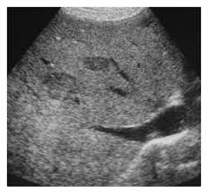 <ul><li><p>increase echogenicity and attenuation </p></li><li><p>hepatomegaly </p></li><li><p>solid liver masses (adenomas) </p></li></ul><p></p>