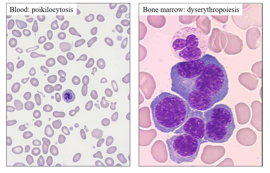 <p>DIAGRAM</p><p>.</p><ul><li><p>myelo = marrow</p></li><li><p>dys = abnormal</p></li><li><p>plasia = making</p></li></ul><p>abnormal blood cell production</p><p></p>