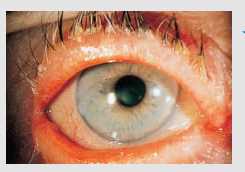 <p>chronic inflam of eyelids @base of hair follicles (<em>S.aureus</em>)</p>