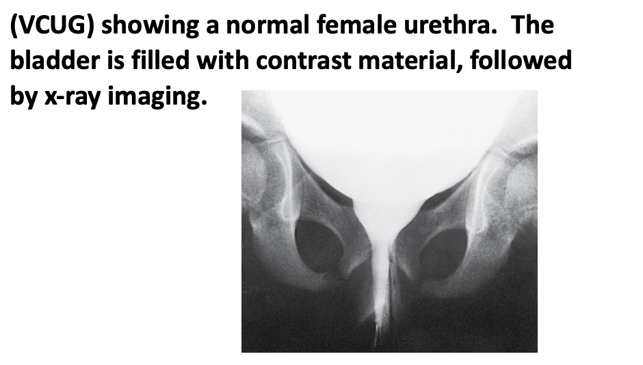 <p>voiding cystourethrogram (VCUG) x-ray</p>