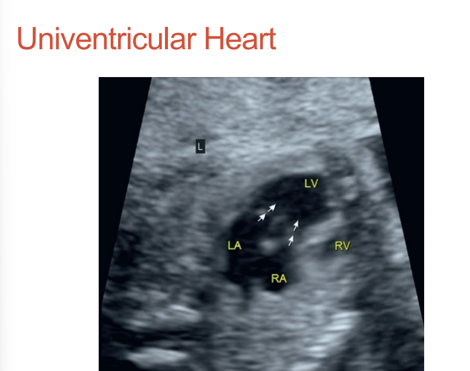 <p>Any CHD where two inflow valves empty into one ventricle • </p><p>May have a second small ventricle •</p><p> May have common valve •</p><p> Called a “Y” type circulation</p>