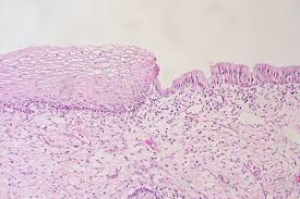 <p>El cáncer cervicouterino es causado por un agente viral, que representa un mayor factor de riesgo?</p>