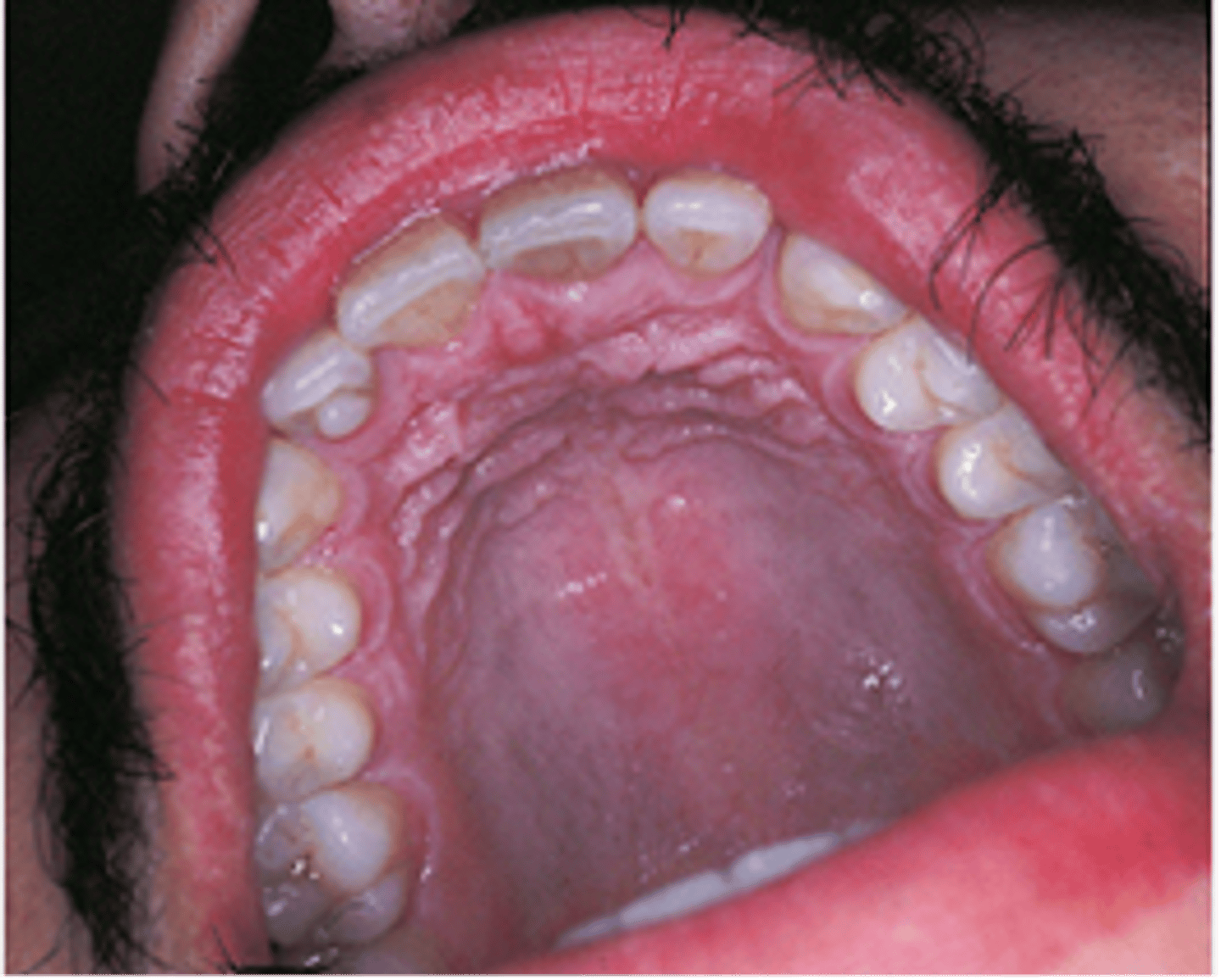 <p>Additional cusp on the surface of an anterior tooth that projects at least half the distance from the CEJ to the incisal edge; usually lingual</p><p><span>The accessory cusp located in the cingulum of the maxillary right lateral permanent incisor is called</span></p>
