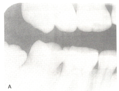 <p>high contrast</p><p>patient's tissue abosrbs ALL photons and don't reach receptor = WHITE image</p>