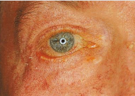 <p>lower eyelid margin turns outward, exposing palpebral conjunctiva</p><p>poor eye drainage and tearing</p>