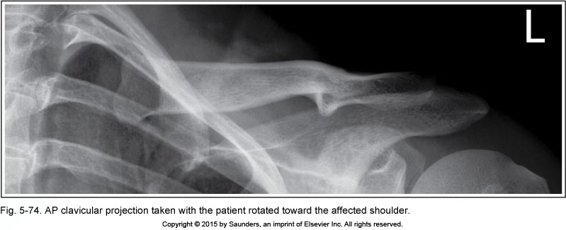 <p>AP clavicle</p>