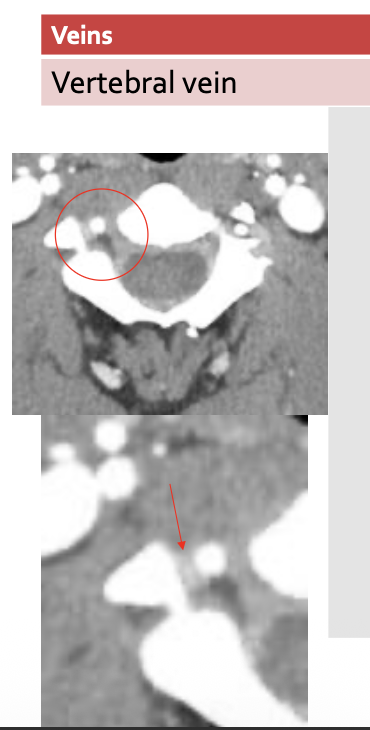 <p>Vertebral vein</p>