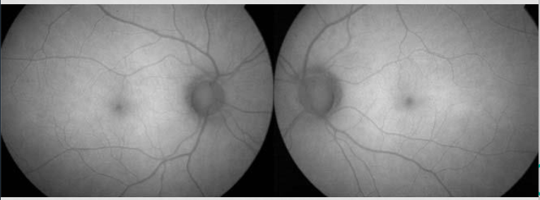 <p>hypo macula ; loss of lipofuscin </p><p>damaged production of lipofuscin = damaged RPE</p>