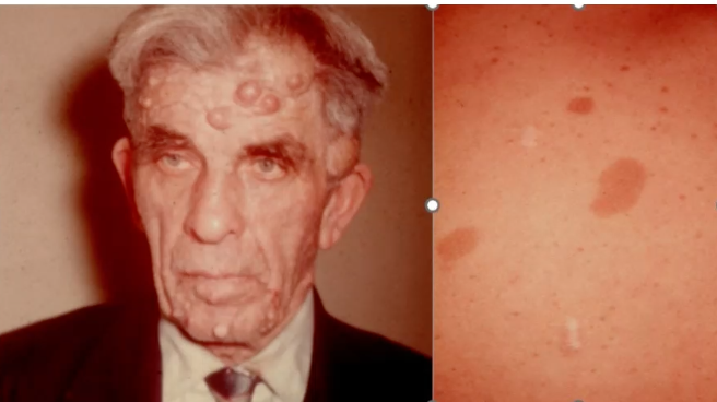 <p>67 y/o man w/ numereous skin nodules and cafe-au lait spost. what are the nodules? </p>