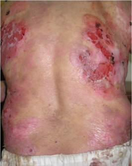 <p><span>•Antibodies targeted at desmosomes</span></p><p><span>•Skin – flaccid blisters, rupture very easily</span></p><p><span>•Intact blisters may not be seen</span></p><p><span>•Common sites – face, axillae, groins</span></p><p><span>•Nikolsky’s sign may be +ve </span></p><p><span>•Commonly affects mucous membranes</span></p><p><span>•Ill defined erosions in mouth</span></p><p><span>•Can also affect eyes, nose and genital areas</span></p>