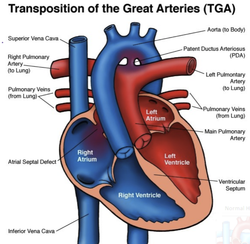 <p>Aorta and pulmonary arteries are switched</p>