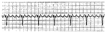 <p>A patient in the ICU complains of light-headedness, nausea, and chest pains. The patient is diaphoretic and has a blood pressure of 90/60 mmHg. A respiratory therapist observes the following ECG pattern:</p><p>a. Lidocaine HCl</p><p>b. Cardioversion</p><p>c. Defibrillation</p><p>d. Epinephrine</p>