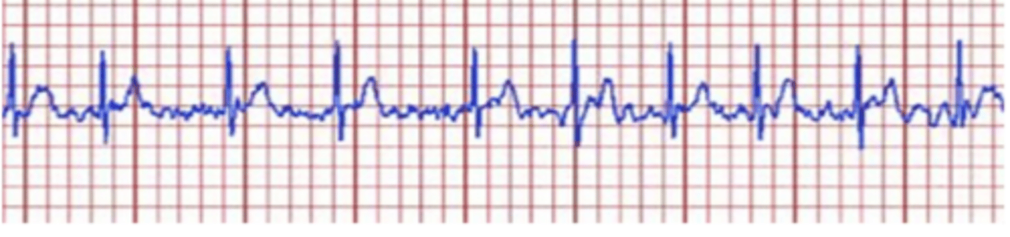 <p>Atrial Fibrillation; Stop exercise and report to the physician</p>