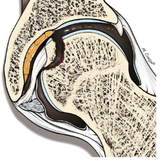 <p>What condition of the ligamentum teres is shown</p>